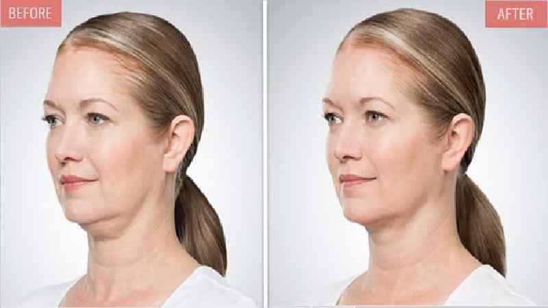 kybella-Diminish The Double Chin