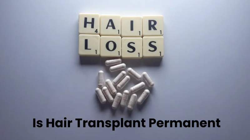 Is Hair Transplant Permanent