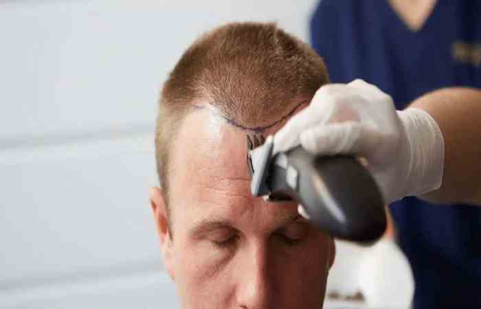 Hair Transplant Permanent